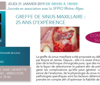 31 012 019 Greffe de sinus maxillaire : 25 ans d'expérience